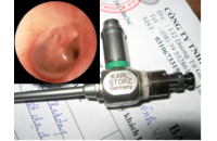 Sửa chữa ống soi tai